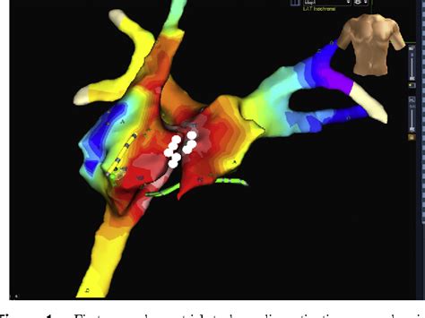 Figure 1 From Para Hisian Atrial Tachycardia Ablation In A Patient With