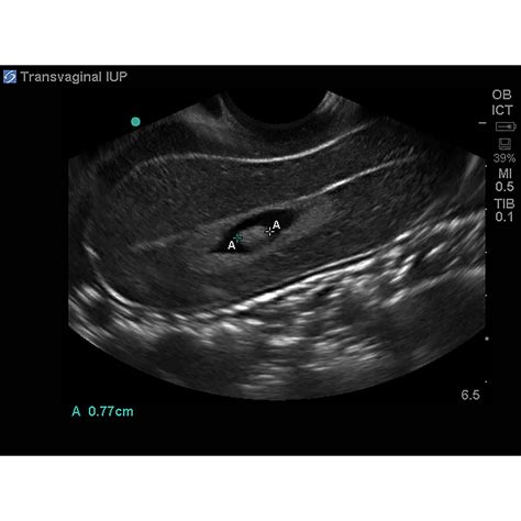 Blue Phantom Ectopic Pregnancy Transvaginal Ultrasound Training Model