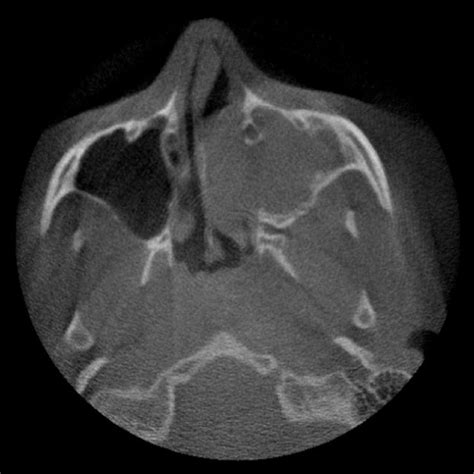 A Sagittal Slice From Cone Beam Computed Tomography Download Scientific Diagram