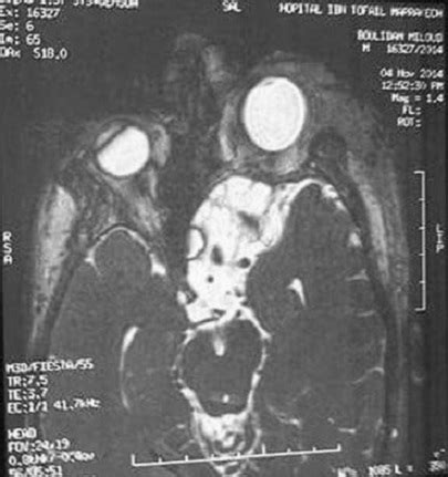 Figure Figure 3 Exophtalmie pulsatile révélant une agénésie sphéno