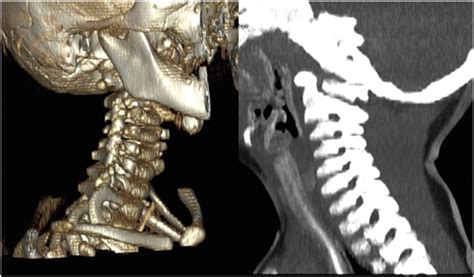 Absent Congenital Cervical Pedicle Nearly Misdiagnosed As A Facet