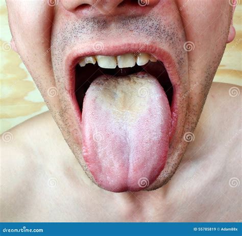 Infection tongue stock image. Image of disorder, illness - 55785819