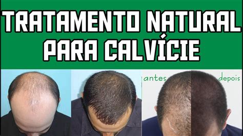 Tratamento Natural para Calvície YouTube