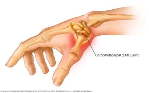 Dolor En La Articulacion Del Dedo Pulgar Cavitaciones