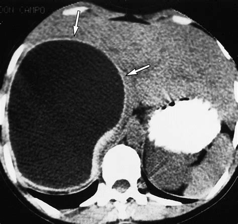 Hydatid Disease Radiologic And Pathologic Features And Complications