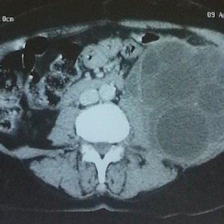 Abdominal Scan Image Of The Multilocular Retroperitoneal Hydatid Cyst