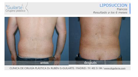 Fotos Antes Y Despu S Liposucci N Lipoescultura Opiniones Mujeres