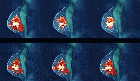 Study: Women With Dense Breast Tissue May Benefit From Regular MRIs | TIME