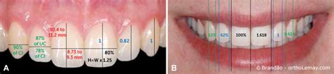 Modification du contour gingival en orthodontie Bücco