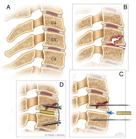 Flexion Vs Extension Teardrop Fracture