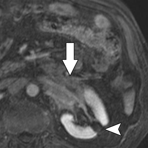 Abdominal Manifestations Of Extranodal Lymphoma Spectrum Of Imaging Findings Ajr