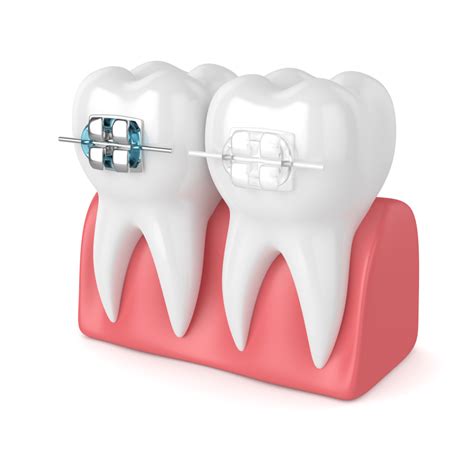 Types Of Braces Garrett Orthodontics