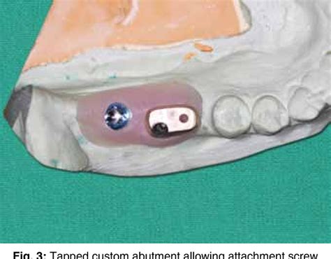 Figure From Management Of A Malpositioned Implant Using Custom