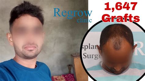 Hair Transplant In India 2021 Nw Grade Ii 1647 Grafts Regrow Clinic Youtube