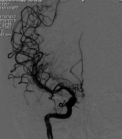 A Ap Cerebral Angiogram Lateral Showing Vasoespams In Anterior And