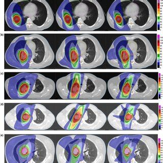 Dosevolume Histograms Dvhs For The Five Patient Cases The Standard