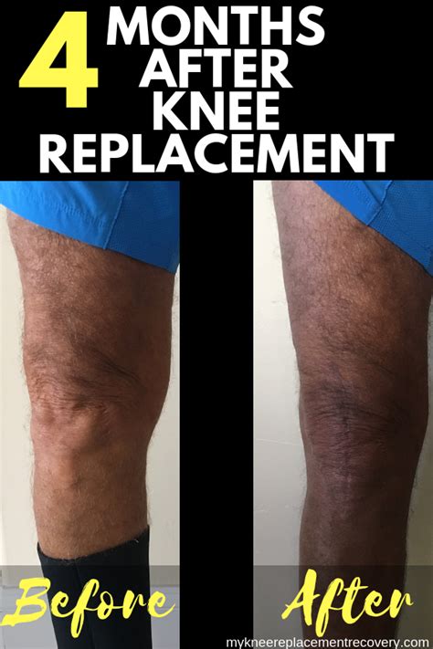 Knee Replacement Scar Pictures : Custom Knee Replacement Surgery ...