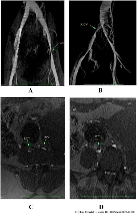 Magnetic Resonance Venography After Cesarean Section Delivery