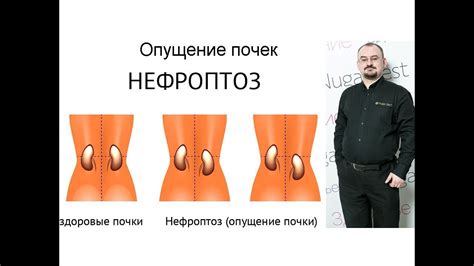 Опущение почек - YouTube