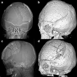 Case 5 3D CT Scan Showing Right Parietal Bone Defect Resulting From