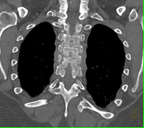 Osteomyelitis T Spine Musculoskeletal Case Studies Ctisus Ct Scanning