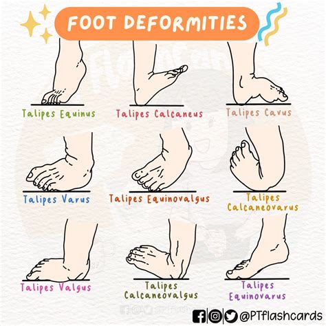 PT Flashcards On Twitter RT PTFlashcards Foot Deformities NOTE