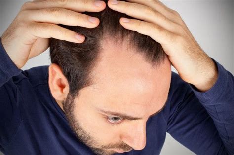 Alopecia Causas Síntomas Calvicie MyCapil