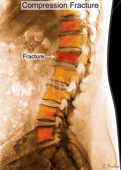 Annotated Color X Ray Lumbar Spine Compression Fracture | X ray, Lumbar, Reflexology massage