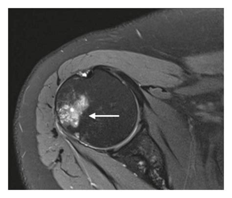 Calcific Tendinitis In A Year Old Female Presenting With Persistent