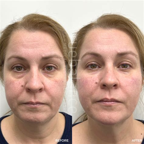 Filler True Balance Medical Spa