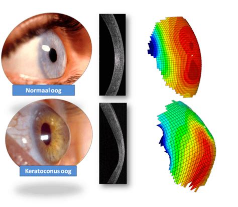 Keratoconus Lenspraktijk Beilen