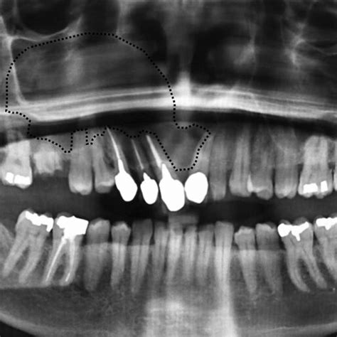 Panoramic Radiograph Revealed Large Right Maxillary Sinus Unilocular