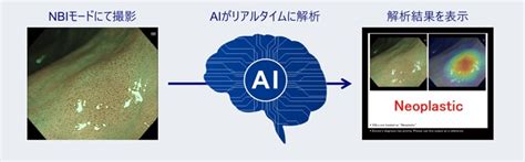 オリンパス、aiを搭載した内視鏡画像診断支援ソフトウェア「endobrain X」を発売 ：2024：ニュース：オリンパス