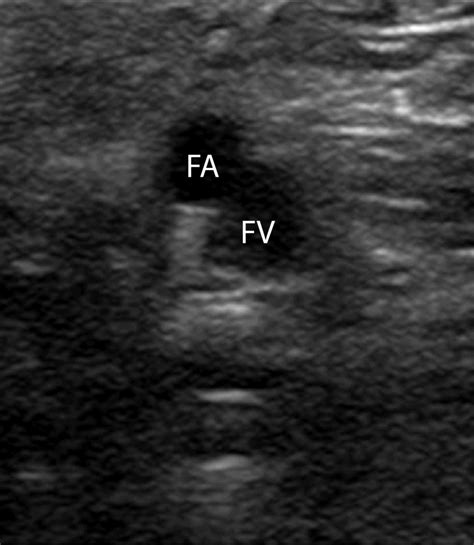 Deep Femoral Artery Ultrasound