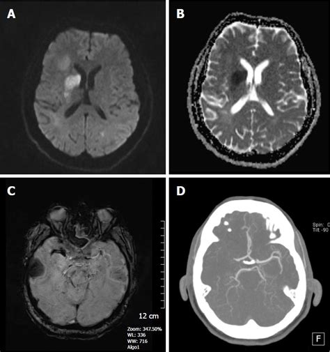 Lentiform Nucleus Mri