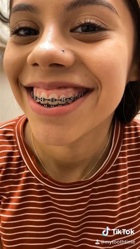 Dental Braces Colors Cute Braces Colors Braces Off Teeth Braces