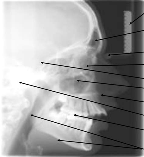 Radiology - Lateral Ceph (Anatomy) Diagram | Quizlet