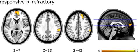 Brain Regions Showing Significant Differences In ALFF Between