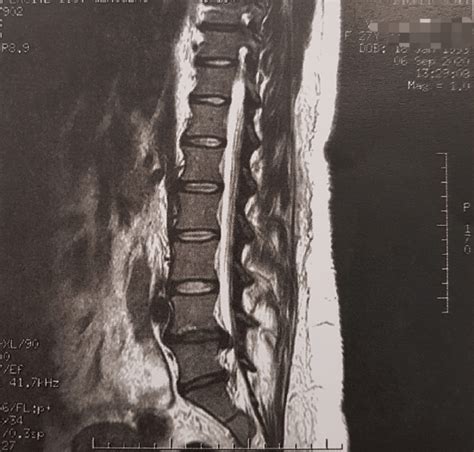 T2 Weighted Mri Scan Sagittal Section Showing A Large L4l5 Lumbar Download Scientific