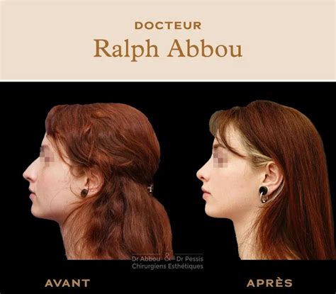 Rhinoplastie Ultrasonique Paris Dr Ralph ABBOU