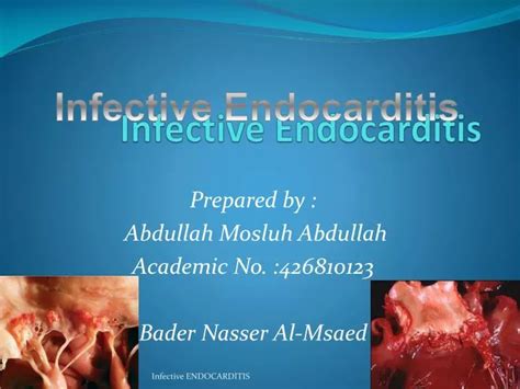 Ppt Infective Endocarditis Powerpoint Presentation Free Download Id 2883947