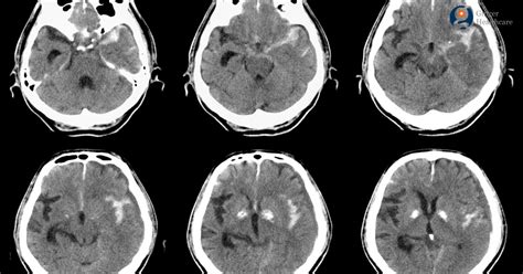 Subarachnoid Hemorrhage: Symptoms, Causes, Risk Factors , Diagnosis, Treatment & Prevention