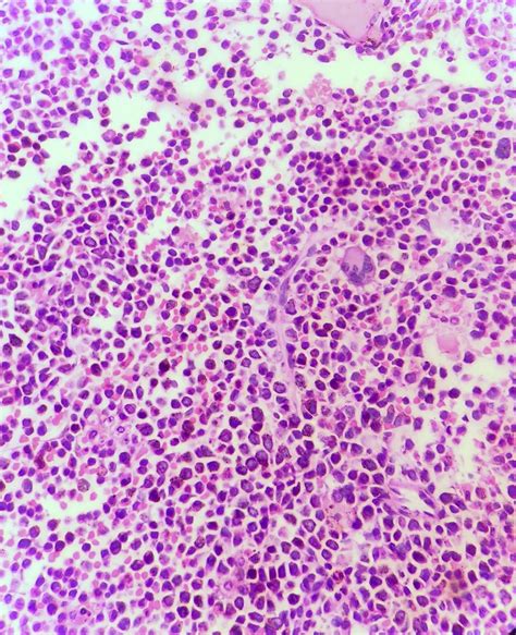 Bone Marrow Biopsy Showing Hypercellular Marrow With Increased