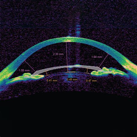 Corneal Pachymetry — Eye Academy