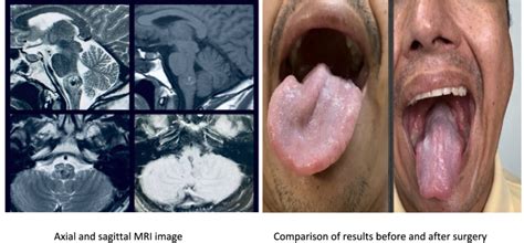 MRI images and clinical symptoms before and after the procedure ...