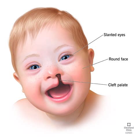 People With Triple X Syndrome