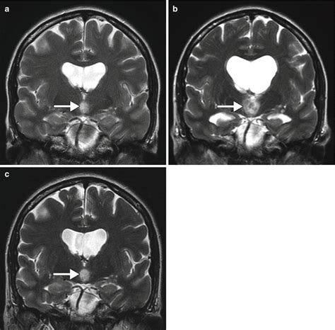 Imaging The Intraoperative And Postoperative Brain Radiology Key