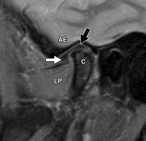 Tmj Mri