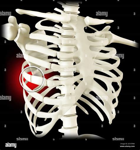 Costilla fracturada fotografías e imágenes de alta resolución Alamy