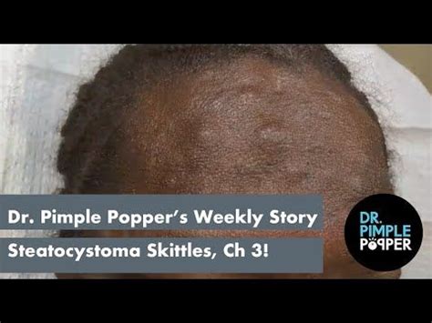 Dr Sandra Lee Aka Dr Pimple Popper Youtube Pimples Squeezing